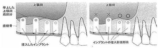 骨を増やす手術