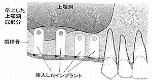 骨を増やす手術