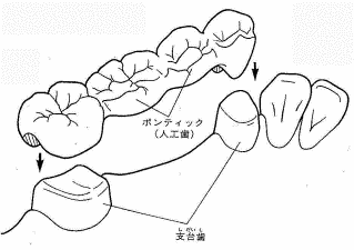 ブリッジ ブリッジ