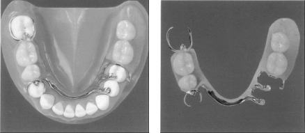 下の奥歯が2本ない場合