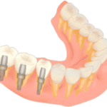 歯を抜くことになる原因
