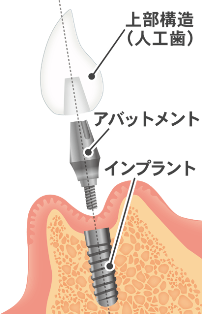 implant-kouzou implant-kouzou
