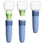 インプラントは外れることがありますか？