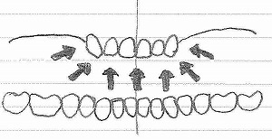 上の前歯がグラグラになります
