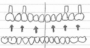 インプラントを入れると…