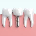 インプラントが抜けてもまた埋められる？