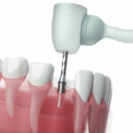 前歯がグラグラしています。インプラントした方が良いですか？