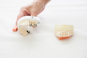 歯を１本失った場合どのような治療を受けるといいですか？