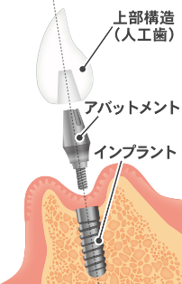 implant-kouzou