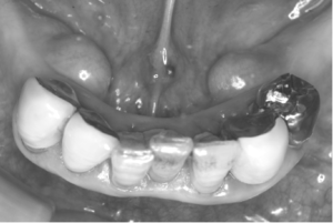 歯ぐきの裏側にこぶ 歯ぐきの裏側にこぶ