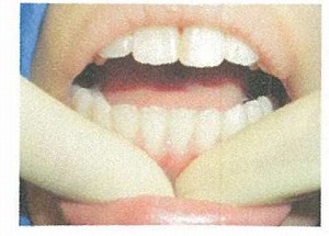 歯ぐきのマッサージ