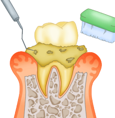 歯周ポケットケア 歯周ポケットケア