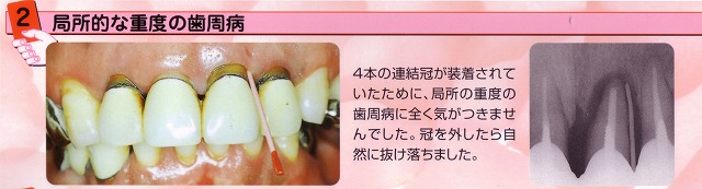 歯周病
