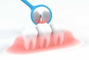 インプラントをする場合、抜けた本数だけ歯を入れなくてはなりませんか？