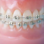矯正治療したのに後戻り？～リテーナーってなに？～