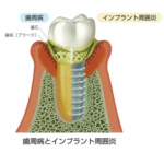 インプラントも虫歯や歯周病のようになりますか。
