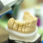 歯のかぶせ物には種類がある？～自分に合った歯を！～