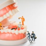 歯周病がひどくてもインプラントはできるの？