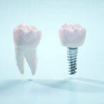 他の歯医者で入れたインプラントの冠が外れたので、新しく作ってほしい