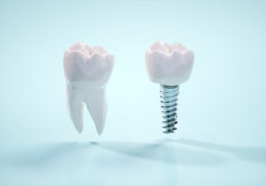他の歯医者で入れたインプラントの冠が外れたので、新しく作ってほしい