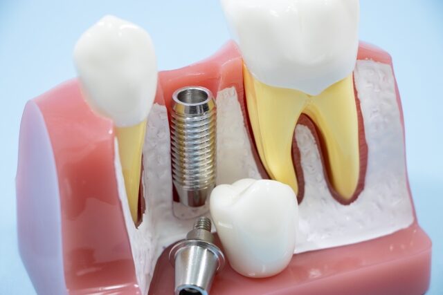 インプラント